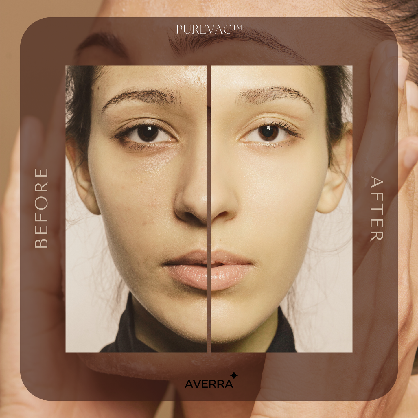 Averra PureVac™ – Deep Cleansing Blackhead Remover